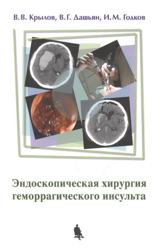 Эндоскопическая хирургия геморрагического инсульта