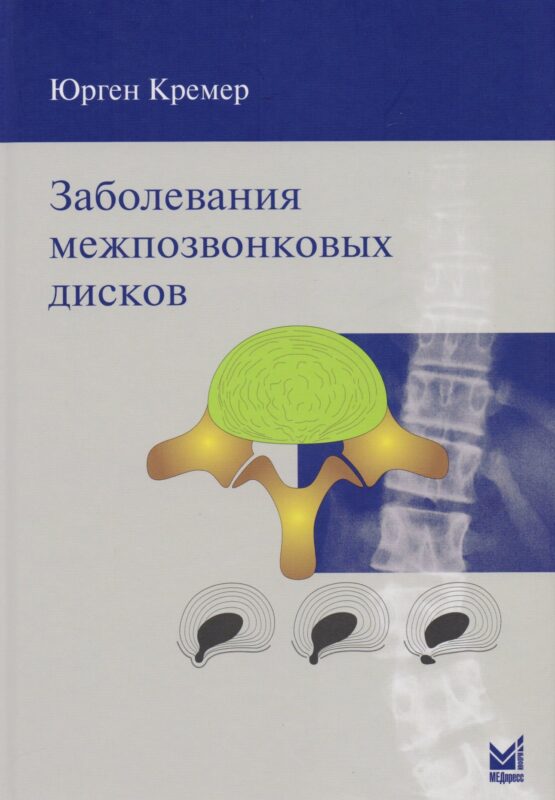 Заболевания межпозвонковых дисков