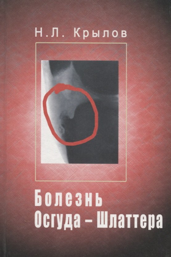 Болезнь Осгуда - Шлаттера